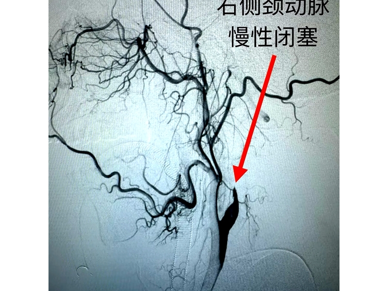 銅川礦務(wù)局中心醫(yī)院成功開(kāi)展首例右側(cè)頸內(nèi)動(dòng)脈慢性閉塞開(kāi)通術(shù) ...